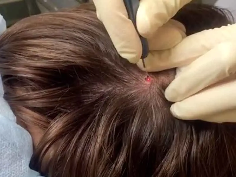 Лазерные технологии в дерматовенерологии с курсом дерматоскопии в Центре лазерной медицины ПСПбГМУ